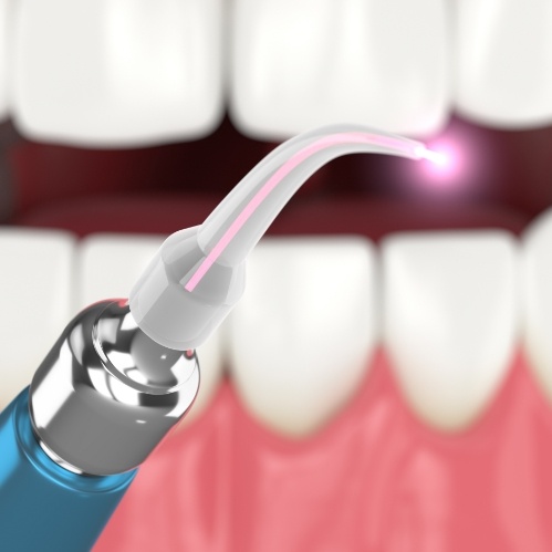 Illustration of dental laser in front of mouth
