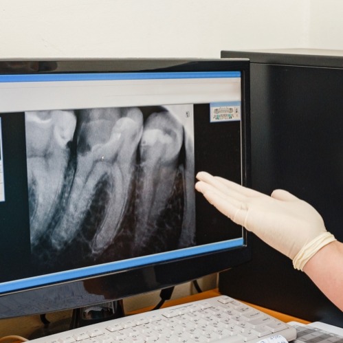 Dentist gesturing to computer screen showing x rays of teeth