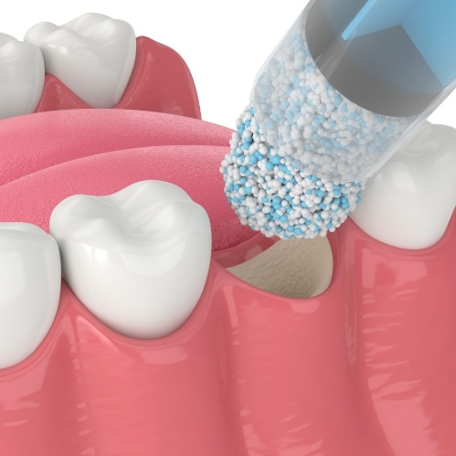 Illustrated of bone grafting material being placed in jawbone after tooth extraction