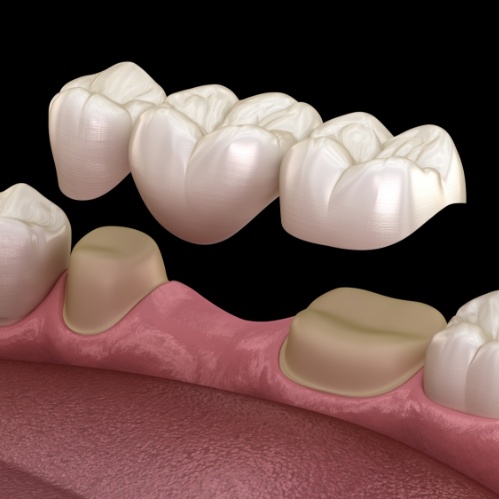 Illustrated dental bridge in Carrollton being placed