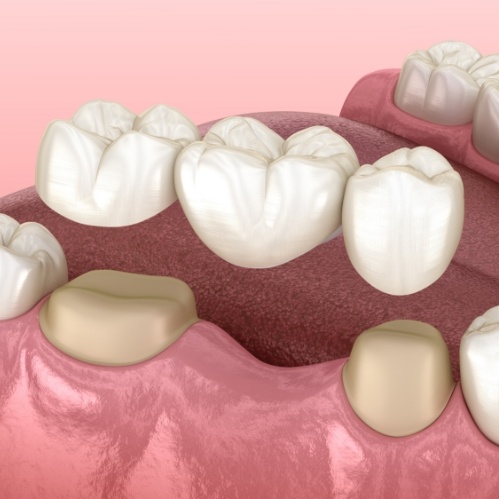Illustrated dental bridge replacing a missing lower tooth