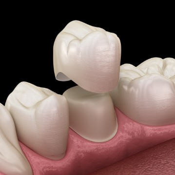 Illustrated dental crown being fitted over a tooth