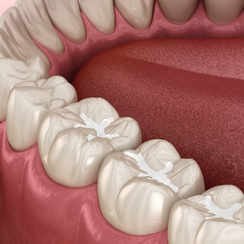 Illustrated row of teeth with dental sealants in Carrollton