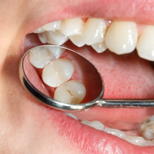Dental mirror in mouth reflecting white teeth