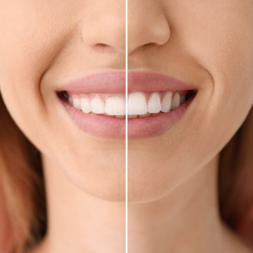 Close up of smile before and after fixing gumline with gum contouring