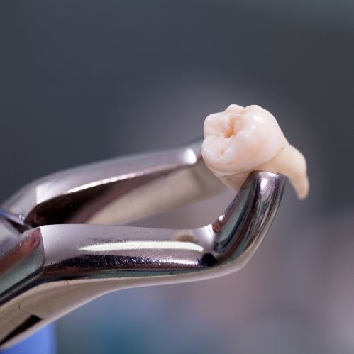 Dental clasp holding an extracted tooth