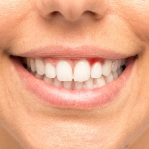 Person smiling with red spot in their gums