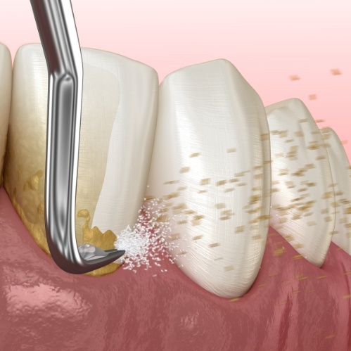 Illustrated dental scaler cleaning plaque buildup from teeth