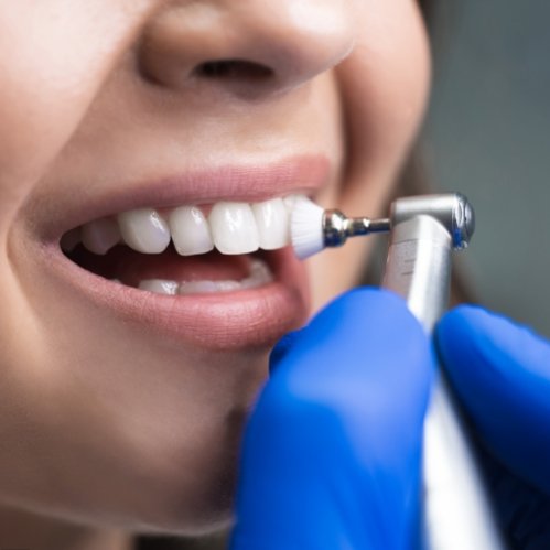 Close up of a dental patient receiving a teeth cleaning