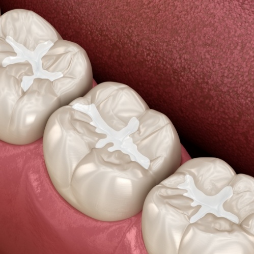 Illustrated row of teeth with dental sealants