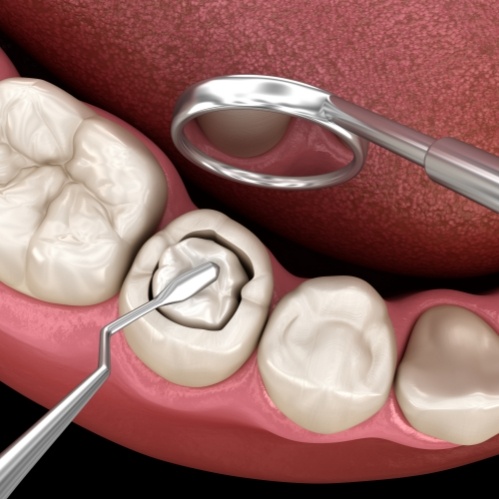 Illustration of a composite filling being placed in a tooth