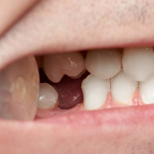 Close up of mouth with one missing lower tooth