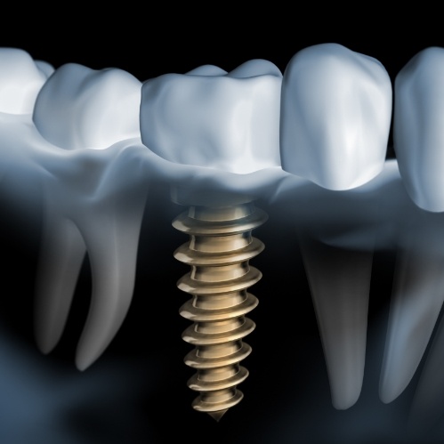 Illustrated x ray of a dental implant replacing a missing lower tooth