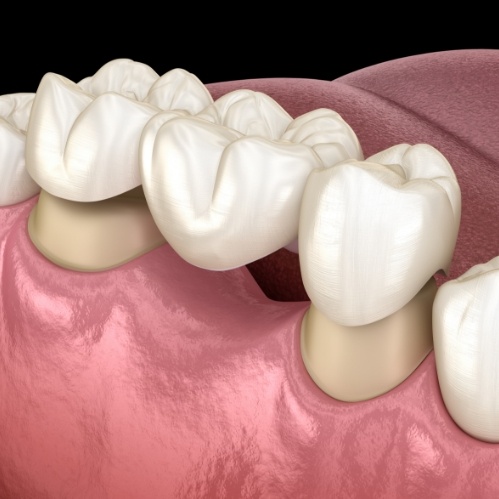 Illustrated dental bridge being fitted over two natural teeth